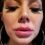 Model warns of ‘boozy Botox parties’ after she was left with swollen lumpy lips