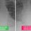 Alarming X-rays show lung difference between vaxxed and unvaxxed Covid patients